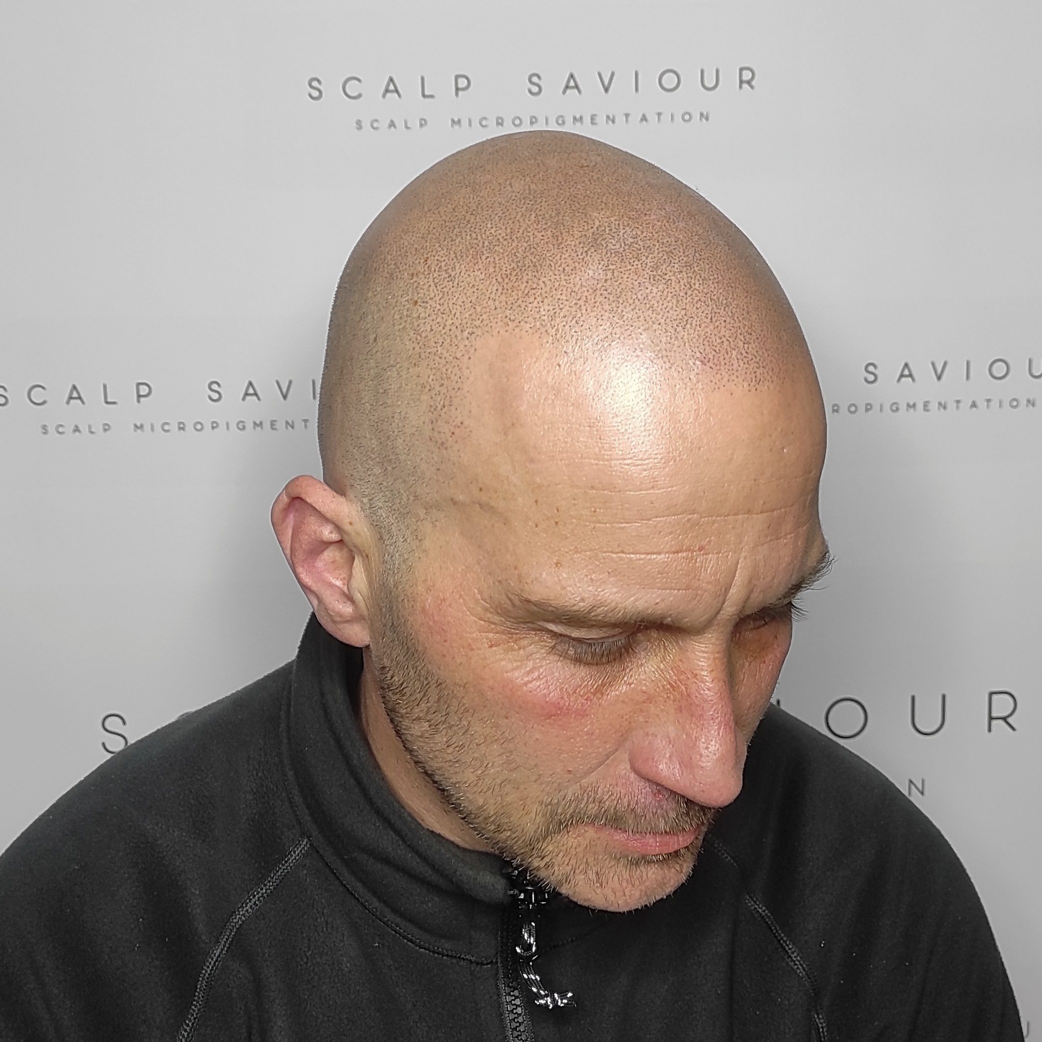 Scalp Micropigmentation Results Angle Headshot