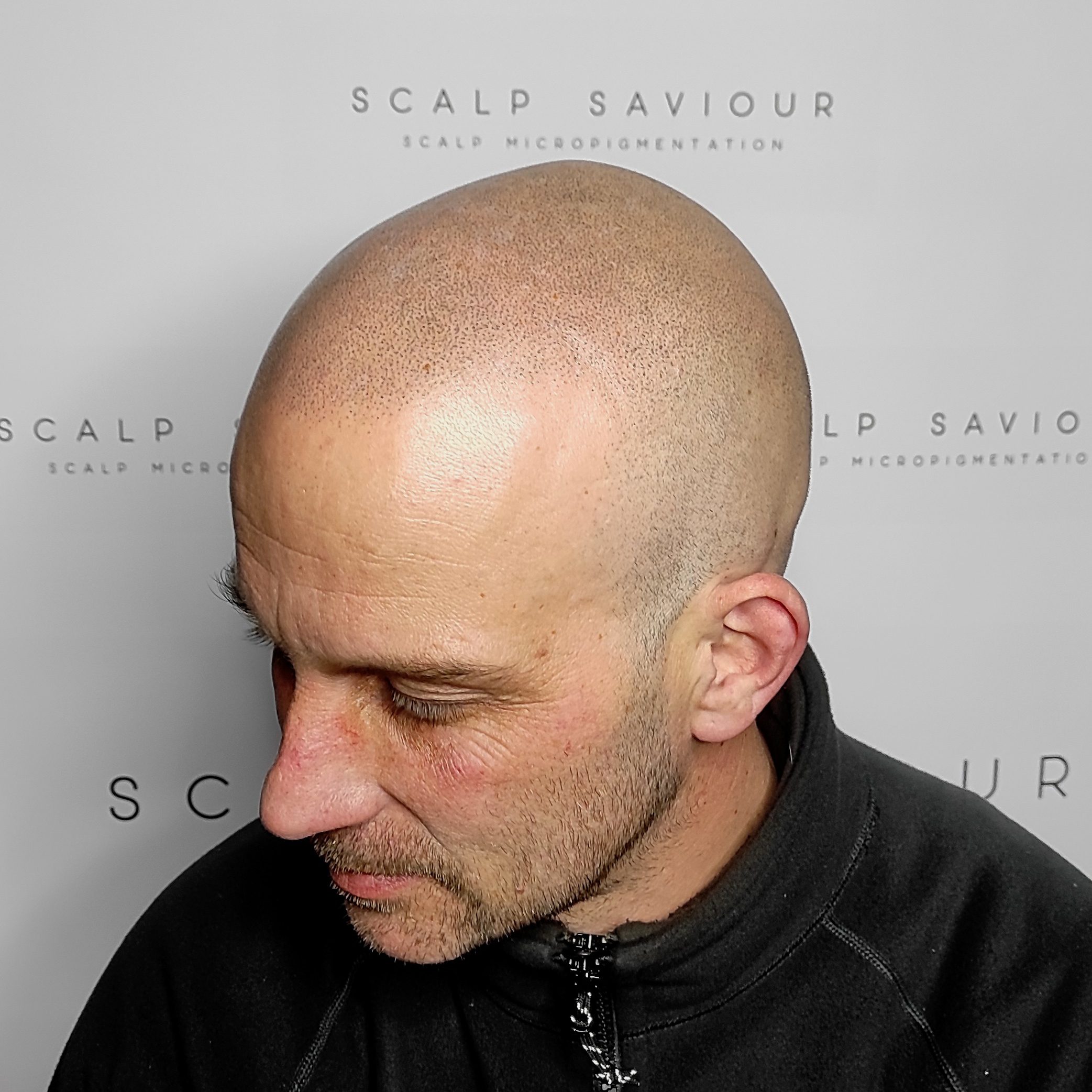 Scalp Micropigmentation Results Angle Left Headshot