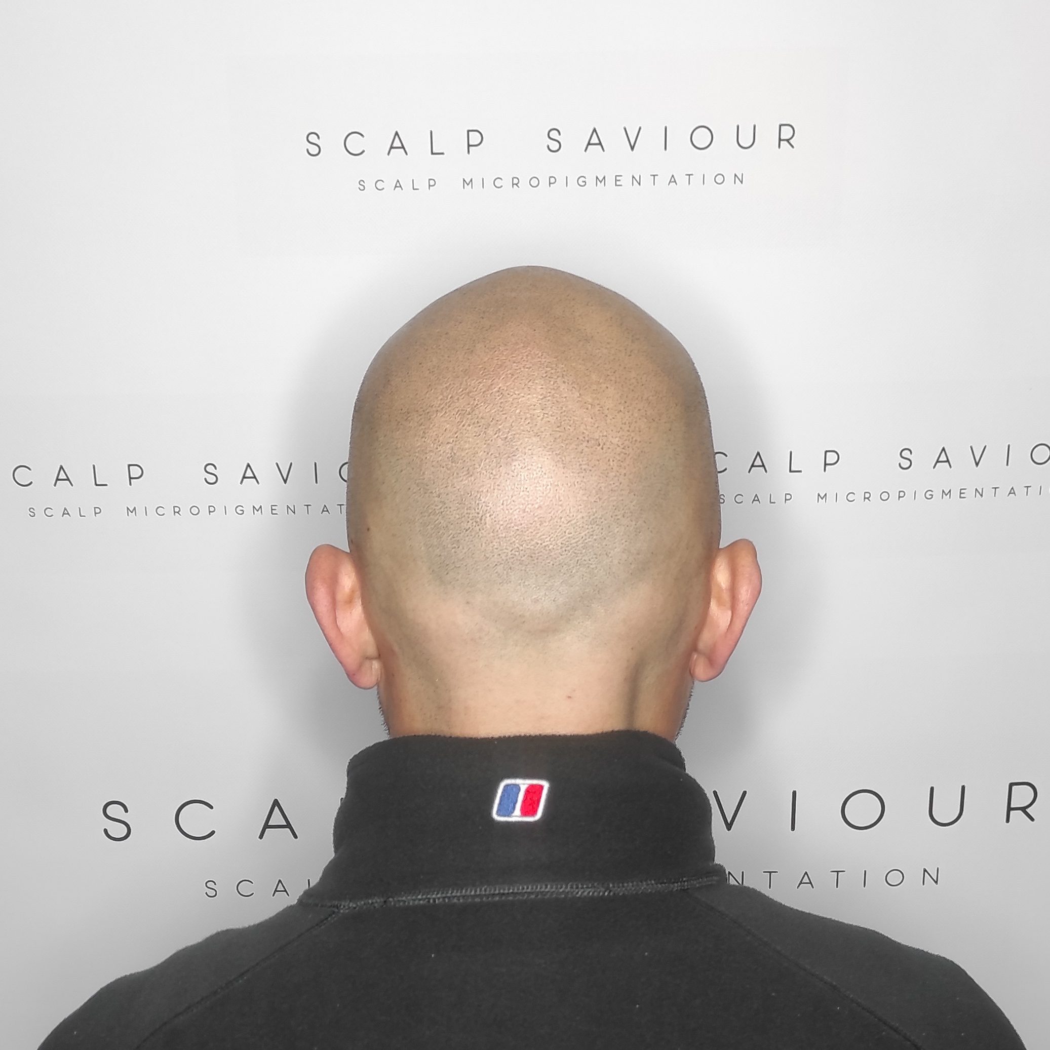 Scalp Micropigmentation Results Back Headshot