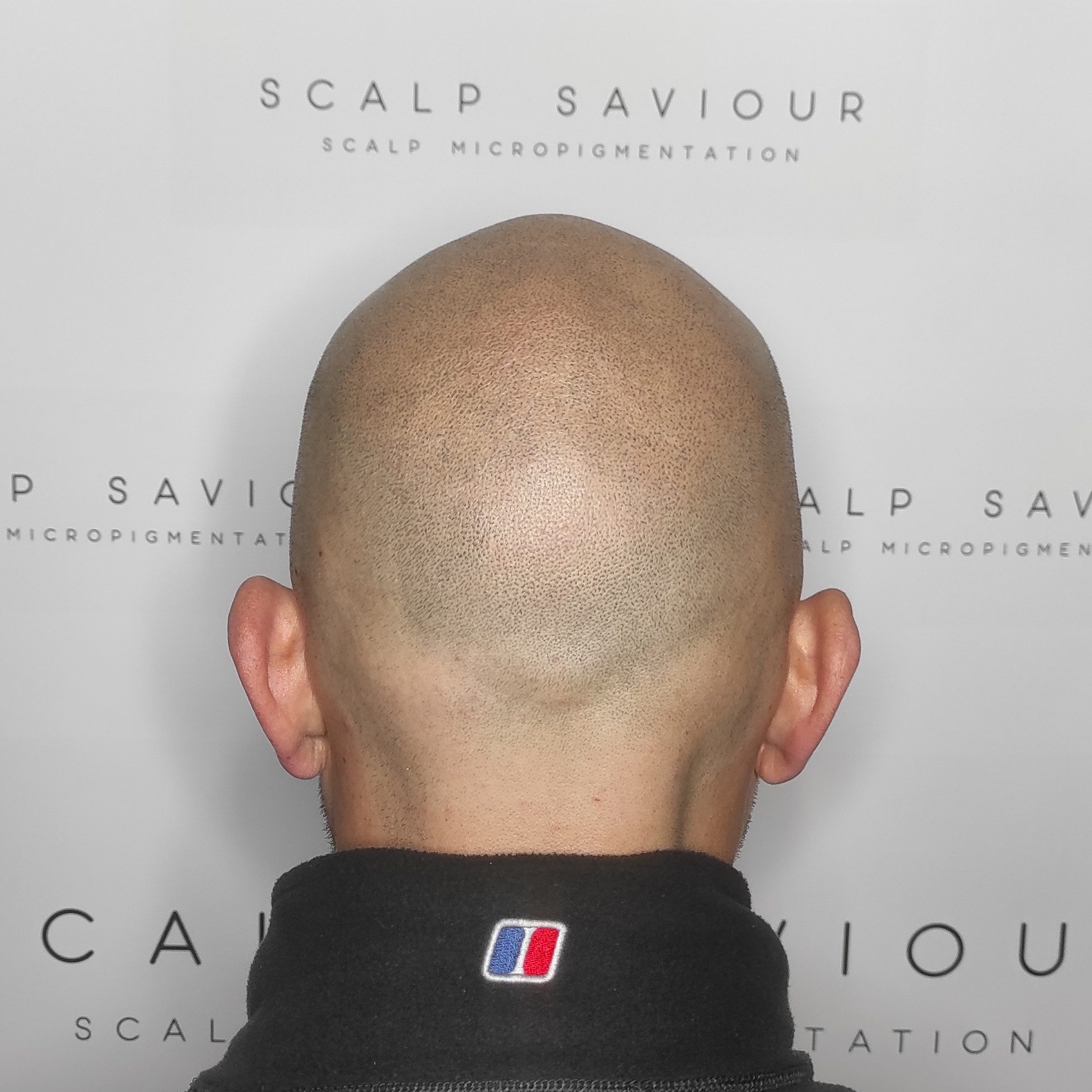 Scalp Micropigmentation Results Back Headshot