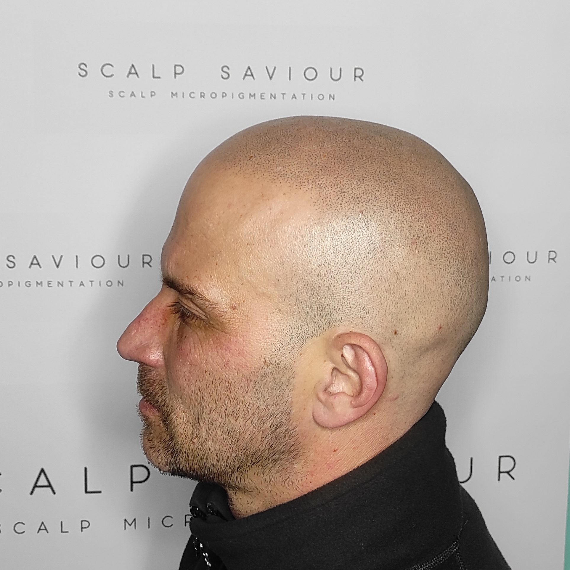 Scalp Micropigmentation Results Side Headshot