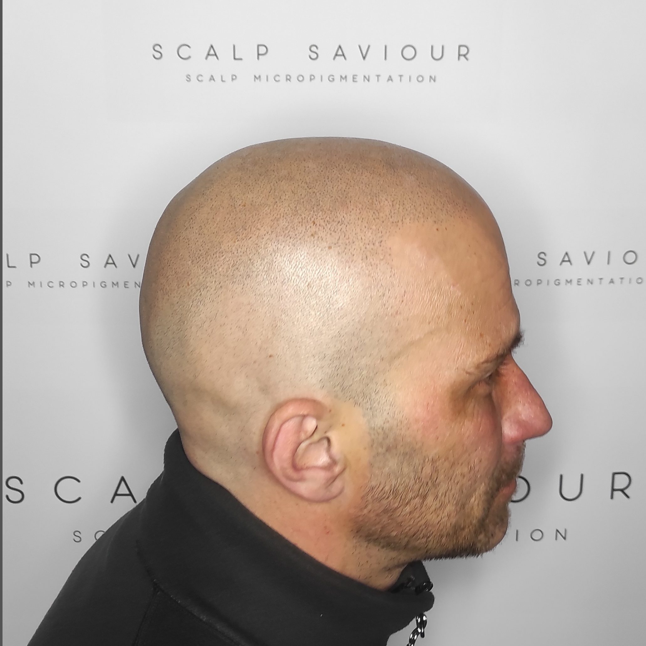 Scalp Micropigmentation Results Side Headshot