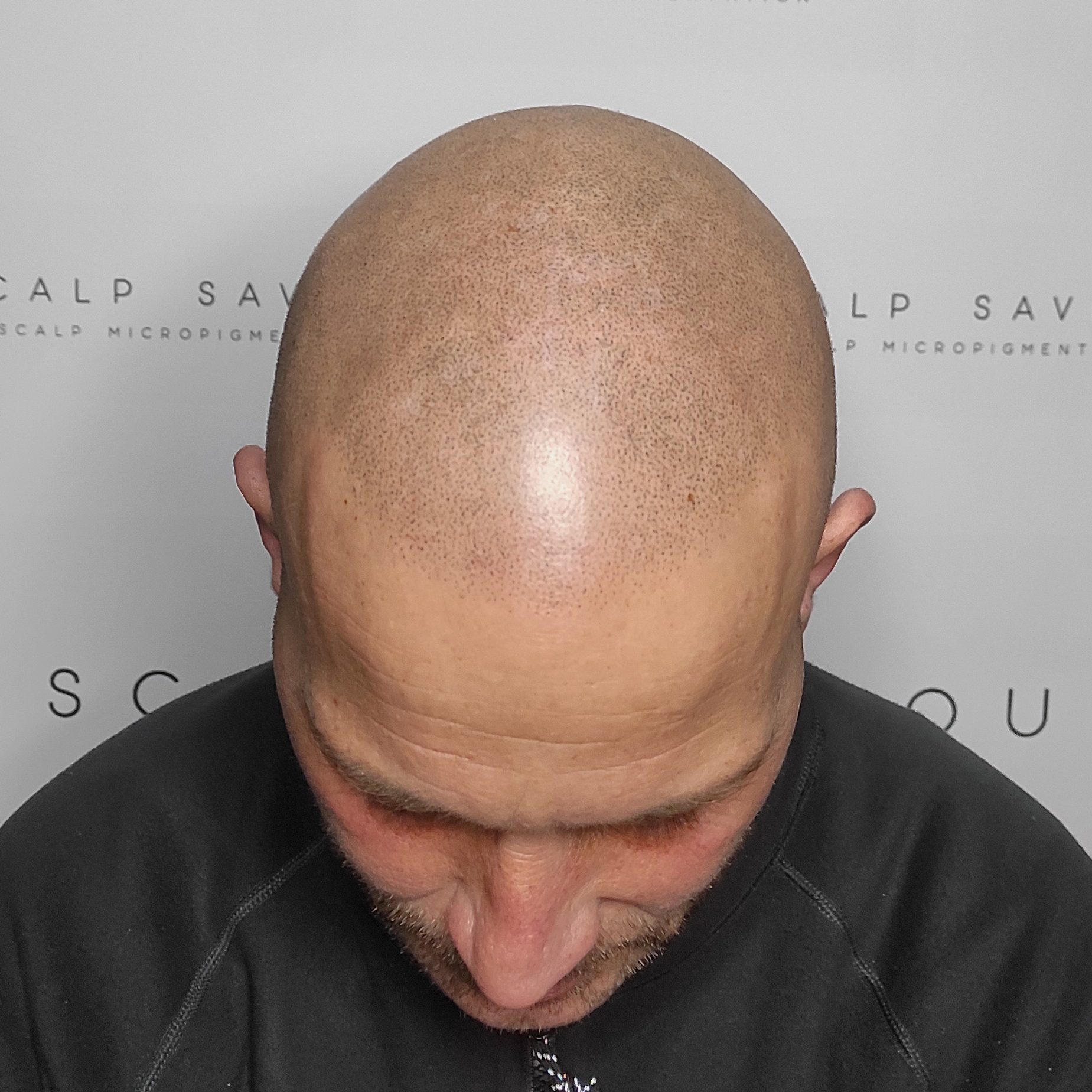 Scalp Micropigmentation Results Top Headshot