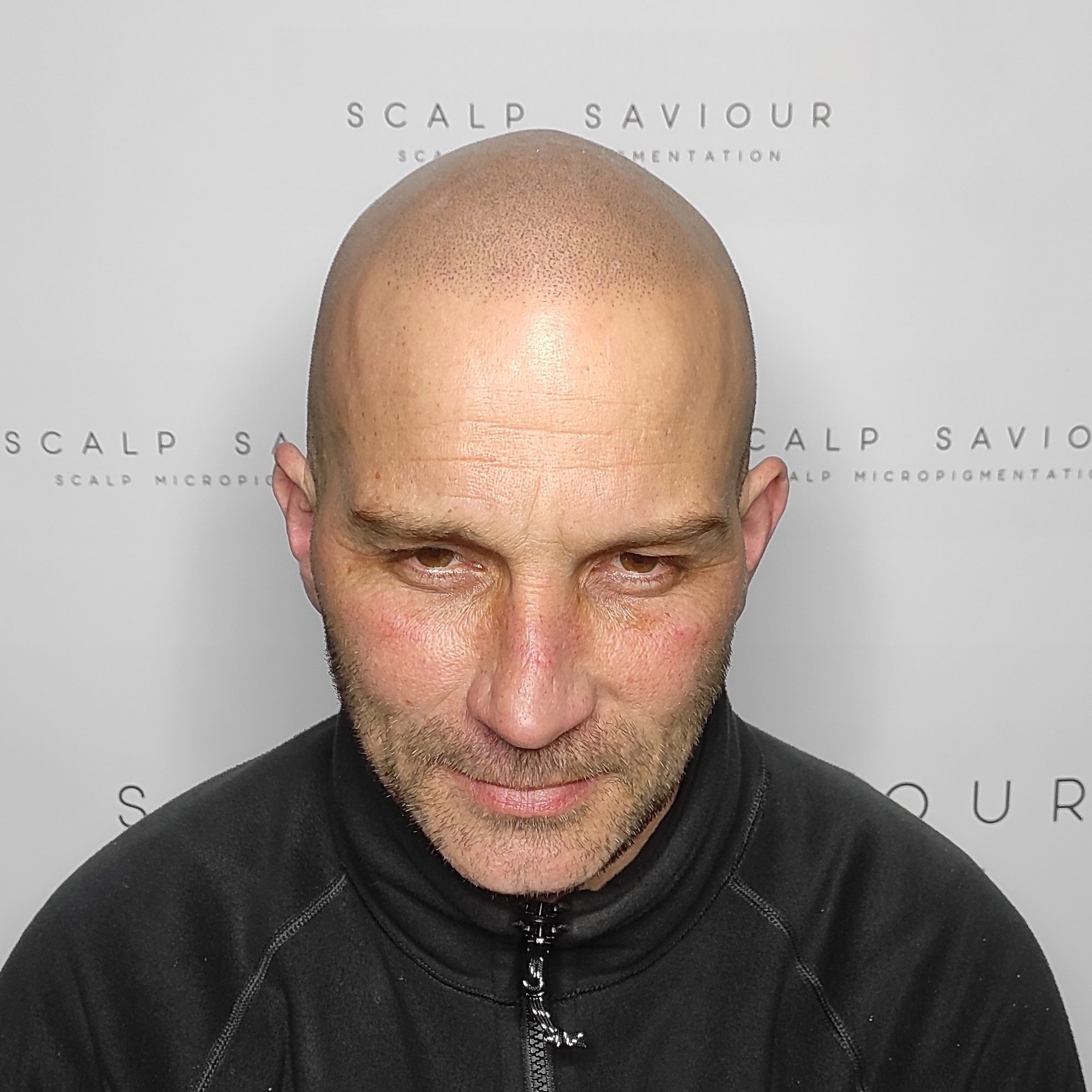 Scalp Micropigmentation Results Front Headshot