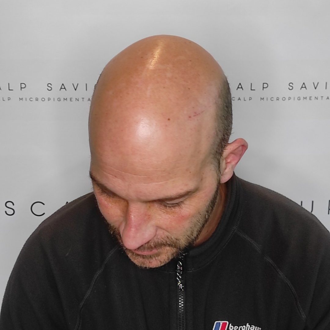 Scalp Micropigmentation Before Results Top Angle