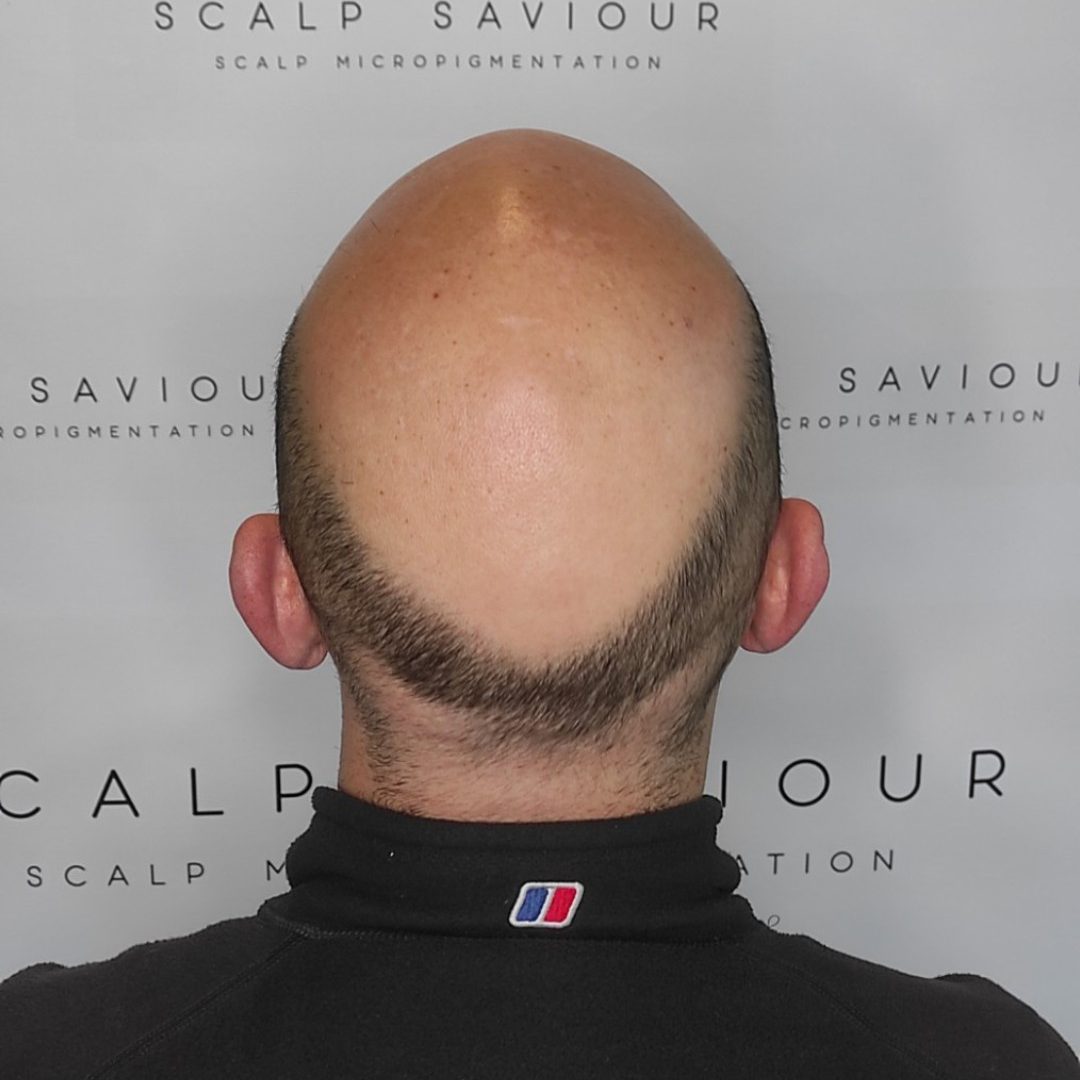 Scalp Micropigmentation Before Results Back Headshot