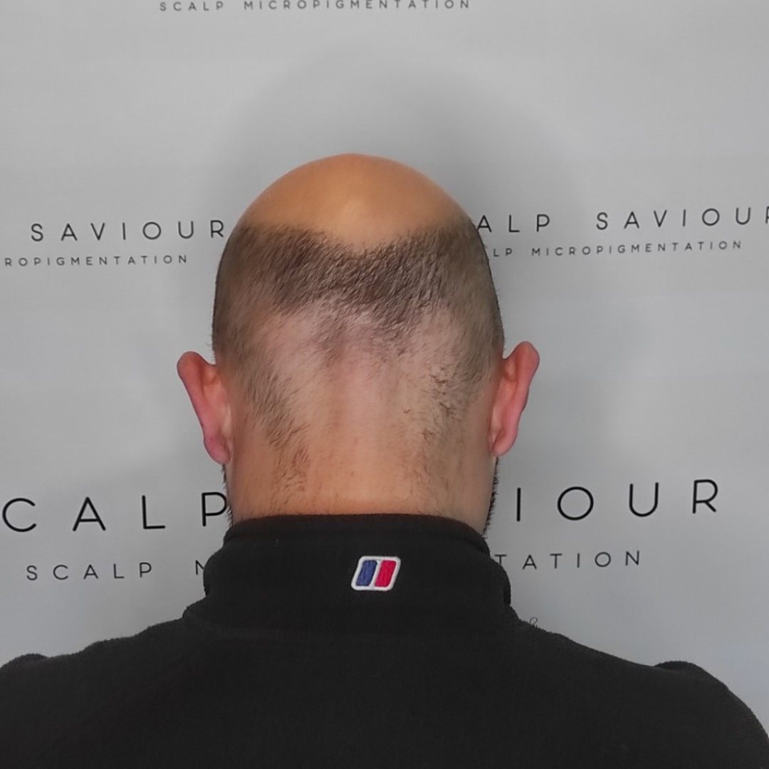 Scalp Micropigmentation Before Results Back Headshot