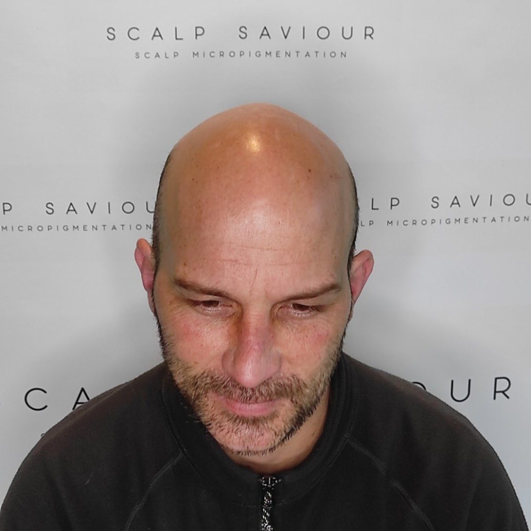 Scalp Micropigmentation Before Results Front Headshot