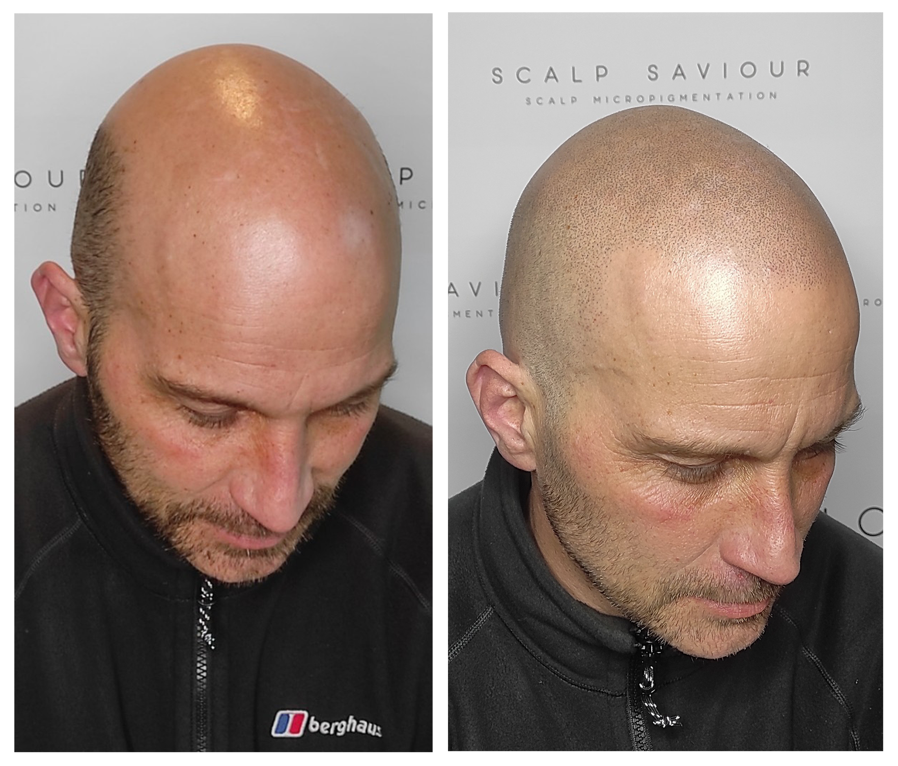 Scalp Micropigmentation Results Comparison